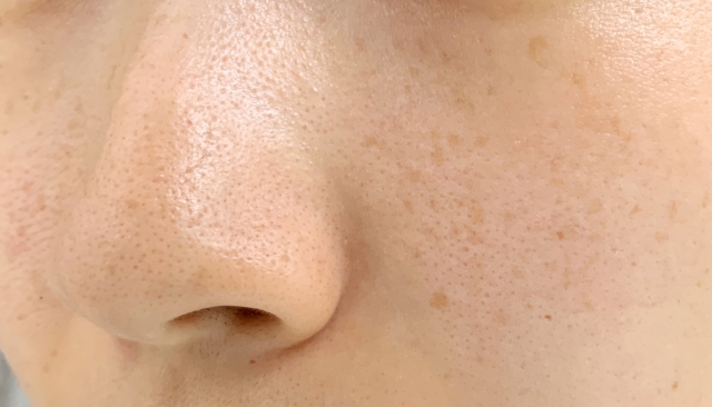 しみ・くすみ・肝斑